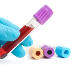 Ręka w niebieskiej rękawiczce trzyma probówkę z krwią. W tle inne probówki. Badanie hemoglobiny glikowanej - norma.