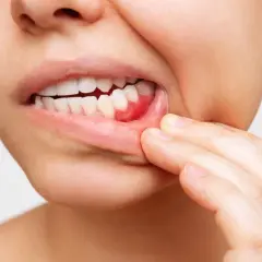 Encía inflamada y enrojecida, señal de qué es la periodontitis.