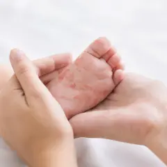 Pieds et mains rouges d'un bébé, possiblement liés au traitement du pied-main-bouche.
