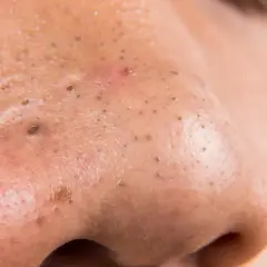 Primer plano de la nariz con poros visibles y filamentos sebáceos. Se aprecian puntos negros y una pequeña espinilla.