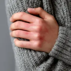 Dłoń z zaczerwienionymi, swędzącymi miejscami, objaw uczulenia na zimno.