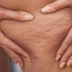 Hände greifen in die Haut und zeigen die typischen Dellen. So entsteht Cellulite.