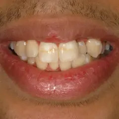 Denti con macchie bianche, possibili segni di carie iniziale.