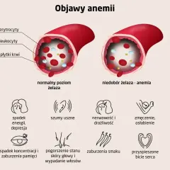Silną anemia objawy: blada skóra, spadek energii, bóle głowy, zmęczenie, szumy uszne, zaburzenia pamięci, wypadanie włosów.