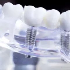 Model szczęki z implantami zębowymi. Sprawdź, czy przysługuje Ci dofinansowanie do implantów zębowych.