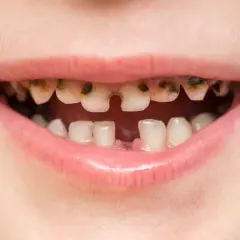 Boca de niño con dientes muy dañados por caries, algunos rotos y oscuros. Es importante recordar que las caries se contagian.