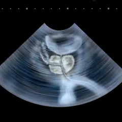 Badanie prostaty per rectum: Bez obaw! Przewodnik krok po kroku
