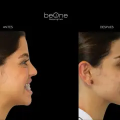 Perfil de una mujer antes y después de usar brackets. La imagen muestra la evolución de su cara y labios.