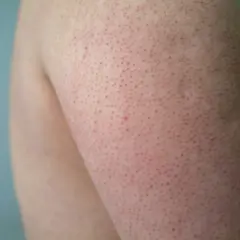Närbild på knottriga ben med små röda prickar. Huden ser lite irriterad ut.