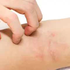Dłoń drapie zaczerwienioną skórę. Czy hydrocortisonum na co pomoże?