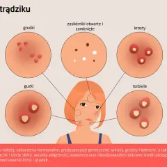Ilustracja przedstawia różne rodzaje krost na twarzy: grudki, zaskórniki, krosty, guzki i torbiele.