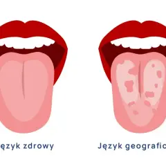 Dwa języki: zdrowy, gładki i język geograficzny z plamkami.