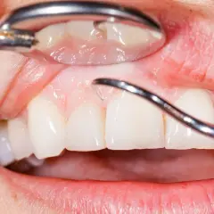 Ropa z zęba? Co pomoże i dlaczego musisz iść do dentysty!