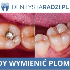 Porównanie zęba z amalgamatową plombą i zęba po wymianie na nową, estetyczną. Kiedy wymienić starą plombę?