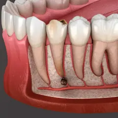 Corte transversal de una muela con caries avanzada y absceso. La infección se extiende a la raíz, mostrando las posibles consecuencias de no extraer una muela con infección.