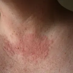 Piel enrojecida y con erupciones en el cuello y pecho, indicativo de una posible alergia al sol.