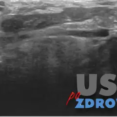 USG obrazujące kamicę ślinianek. Widoczny kamień w przewodzie ślinianki, wskazany niebieską strzałką.