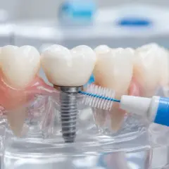 Modello dentale con impianto e spazzolino interdentale. Dopo la pulizia dei denti si può mangiare senza pensieri.