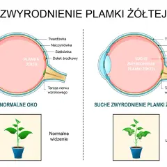 Porównanie zdrowego oka z suchym zwyrodnieniem plamki żółtej, pokazujące utratę ostrości widzenia.