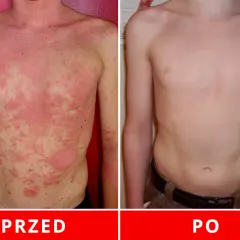 Łuszczyca: Metody leczenia w Polsce od maści po terapie biologiczne