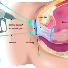 Illustration visar en medicinsk procedur för vaginal åtstramning med en kamera och en plastpåse som används för att dra åt.