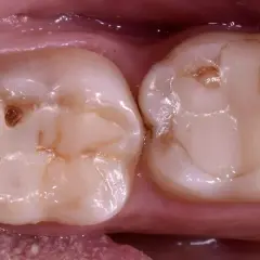 Due denti con un piccolo buco nel dente senza carie, forse un segno di usura o un'antica otturazione.