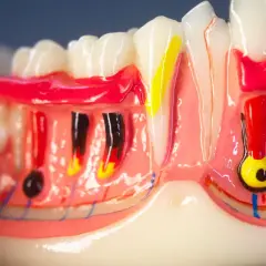 Modello anatomico di denti e gengive, con evidenziati nervi e vasi sanguigni. Si nota il colletto dentale e la struttura ossea.