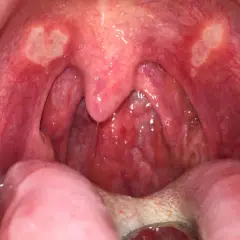 Gola arrossata con afte sul palato e sulle tonsille. Si notano lesioni biancastre e infiammazione.