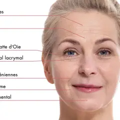 Visage d'une femme montrant les rides frontales, du lion, pattes d'oie, nasogéniennes, plis d'amertume et sillon labio-mental.