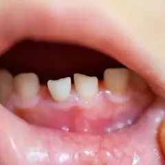 Bocca di bambino con denti da latte spuntati, gengive arrossate. Potrebbe essere la **febbre da dentizione**.