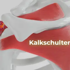 Kalkschulter: Ablagerungen im Schultergelenk. Was tun? Hier sehen Sie die Ursache von Schulterschmerzen.