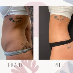 Liposukcja brzucha: Ile kosztuje? Pełny cennik i ukryte wydatki