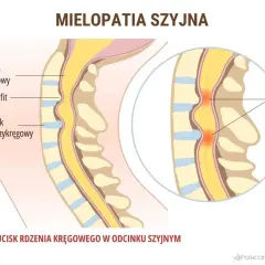 Ucisk rdzenia kręgowego w odcinku szyjnym, prowadzący do mielopatii. Osteofity i krążki międzykręgowe uciskają rdzeń, powodując jego uszkodzenie.