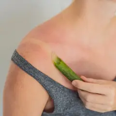 Donna applica gel di aloe vera su una scottatura solare, sfruttando i benefici per la pelle.
