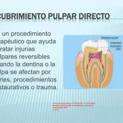Diagrama de un diente mostrando el recubrimiento pulpar directo, un procedimiento para tratar injurias reversibles en la pulpa dental.