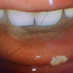 Nahaufnahme der Lippen und Zähne. Kleine, weiße Flecken auf der Innenseite der Lippe, die auf eine HPV-Infektion im Mund hindeuten könnten.