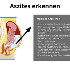 Illustration zeigt Bauchraum mit Flüssigkeitsansammlung. Symptome wie Bauchumfangszunahme und Völlegefühl deuten auf Wasser im Bauch hin.