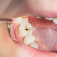 Diente con una cavidad oscura, mostrando por qué salen caries.