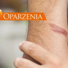 Oparzenia na skórze. Dowiedz się, jak udzielić pierwszej pomocy przy oparzeniach, aby zminimalizować szkody.