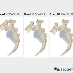 Illustrationen zeigen fünf Grade der Spondyloptose, von Grad I (<25%) bis Grad V (>100%), die den **Meyerding Grad 1 Behinderungsgrad** und weitere Stufen darstellen.