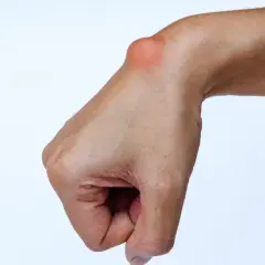 Polso con cisti da sforzo mano, un rigonfiamento visibile sulla parte superiore del polso, indice di un problema legato all'uso eccessivo.