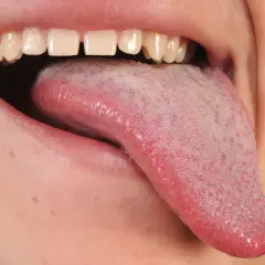 Boca abierta mostrando lengua rosada con pequeñas protuberancias rojas, quizás por eso salen granos en la lengua.