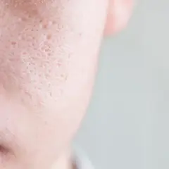 Primer plano de piel con poros visibles, ideal para quienes buscan cómo cerrar poros cara y mejorar la textura de su piel.