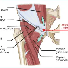 Anatomia pachwiny piłkarza: mięsień prosty brzucha, wiązadło pachwinowe, mięsień biodrowo-lędźwiowy, mięsień krawiecki, pierścień pachwinowy powierzchowny, mięsień grzebieniowy, mięsień przywodziciel długi. Miejsce bólu i uszkodzenia.