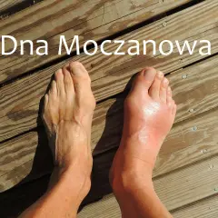 Dna moczanowa powoduje ból i obrzęk stawów, jak widać na opuchniętej stopie.