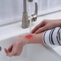 Chłodzenie oparzenia 2 stopnia pod bieżącą wodą. Na przedramieniu widoczna jest czerwona, pęcherzowa rana.