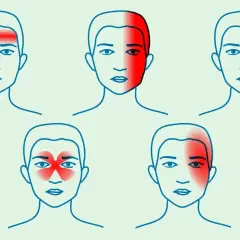 Ilustracje przedstawiają różne lokalizacje bólu głowy: czołowy, skroniowy, wokół oka, zatokowy i jednostronny.