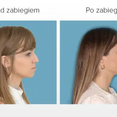 Przed i po zabiegu korekty profilu. Widoczna poprawa linii żuchwy, która wcześniej była lekko krzywa.