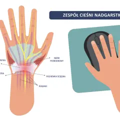Anatomia cieśni nadgarstka i dłoń trzymająca myszkę. Ilustracja pokazuje ucisk na nerw pośrodkowy, który może prowadzić do bólu i drętwienia, a także do konieczności ubiegania się o odszkodowanie po operacji cieśni nadgarstka.