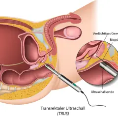 Wichtige Informationen zur Vorsorge Prostatakrebs: Tests und Empfehlungen